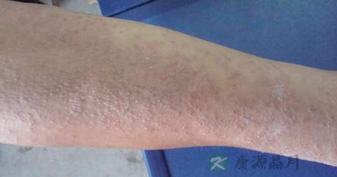 什么是神经性皮炎