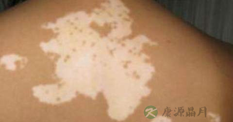 什么是白癜风