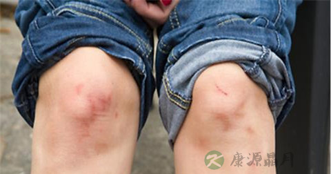 强直性关节炎怎么办