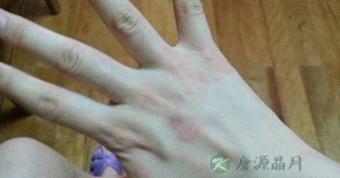 丘疹的发病原因