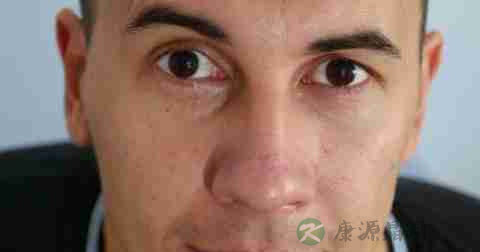 过敏性眼睑皮炎病因