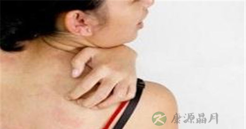脂溢性皮炎为什么复发