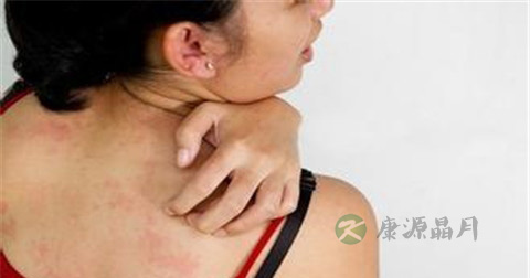 得了牛皮癣吃什么药好
