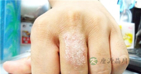 莫匹罗星软膏说明书