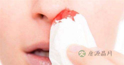 流鼻血治疗方法