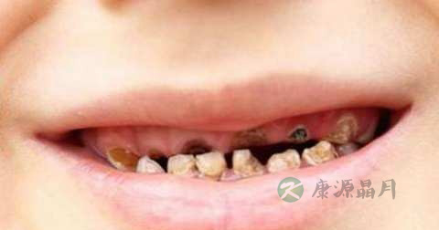 脆骨病怎么治