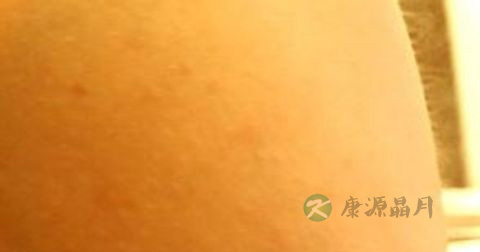 麻疹是传染病吗