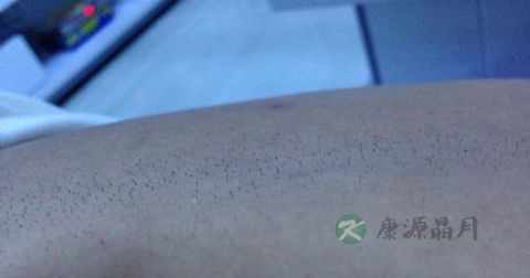 毛囊炎怎样好的快