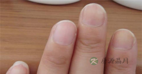 得了甲沟炎怎么治