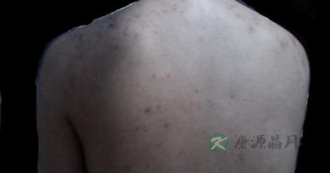 毛囊炎怎样好的快