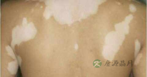 白癜风用针扎放血能治好吗