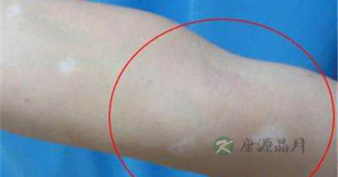 白癜风用针扎放血能治好吗