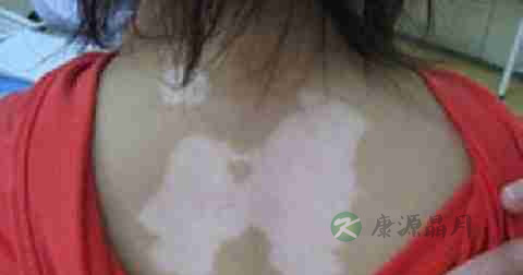 白斑能治好吗