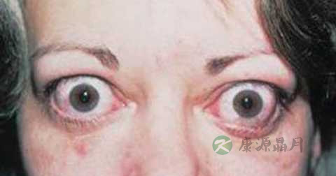 甲亢突眼能治吗