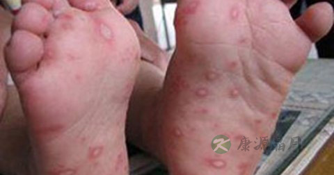 传染性红斑的传播途径