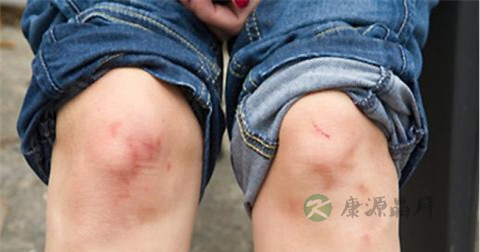 得了骨质增生怎么办
