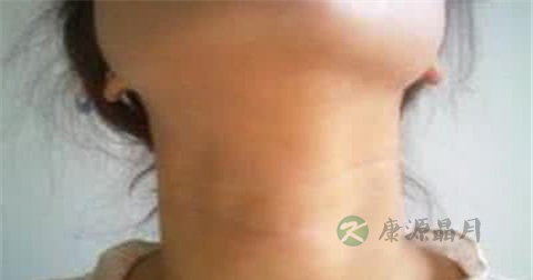 淋巴癌治疗方法