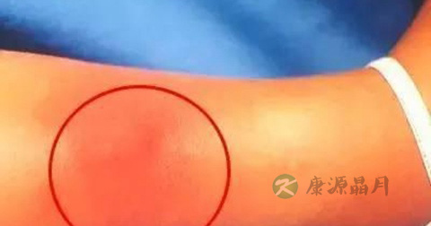 丹毒能否根治