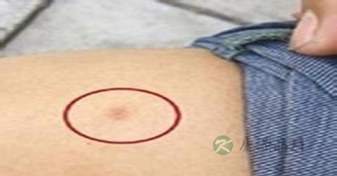 艾滋病如何预防控制