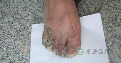 如何去除瘊子