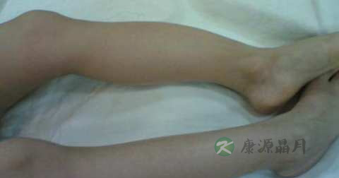 脆骨病怎么治