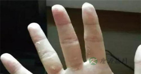 手长癣怎么治