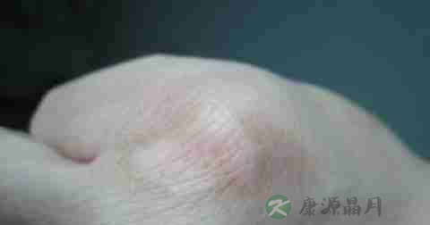 白斑能治好吗