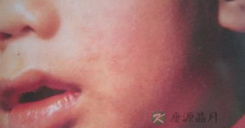 传染性红斑的传播途径