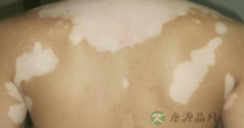 手上白癜风怎么治