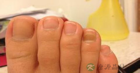 灰指甲是传染病吗