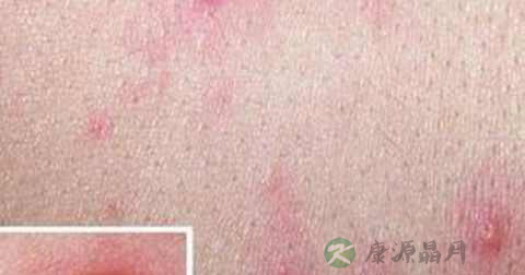 性病的潜伏期是多久