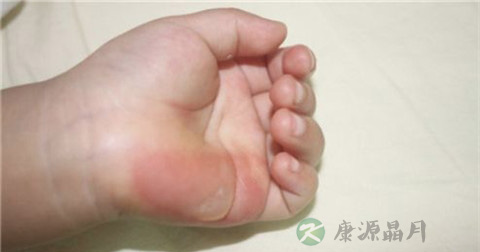 烫伤后起水泡怎么止痛