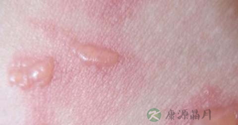 如何处理烫伤的大水泡