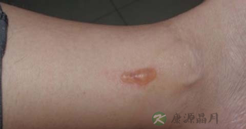 如何处理烫伤的大水泡