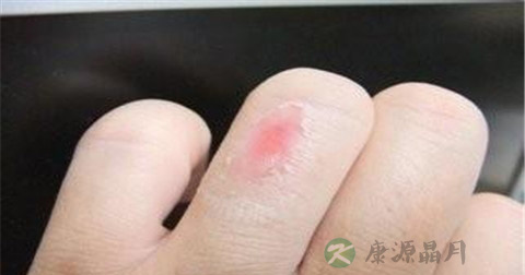 热水烧伤怎么紧急处理