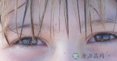 激光治疗近视价格表