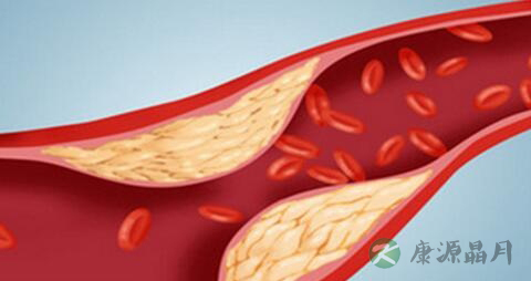 动脉粥样硬化危害