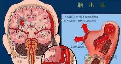 脑出血人的症状