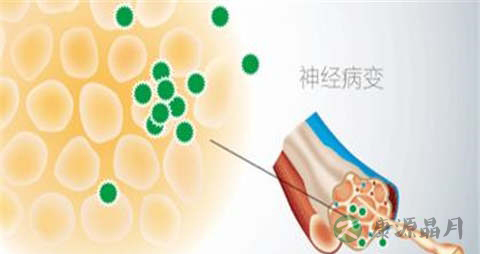 糖尿病神经病变症状及危害