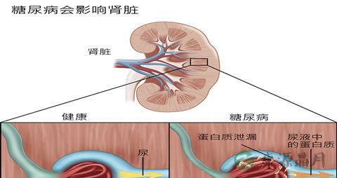 糖尿病肾病怎么治