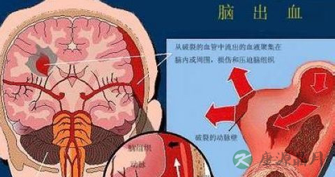 脑出血病理变化