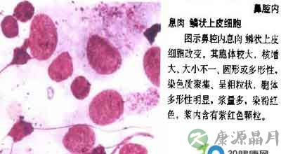 癌症百科：什么是鳞癌？