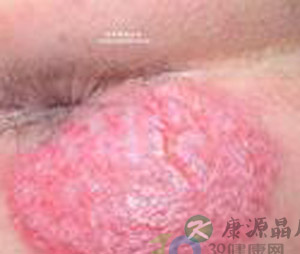 肛周湿疹
