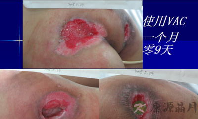 17岁少女患巨大压疮浑然不知