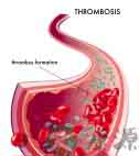 血栓形成原因是什么