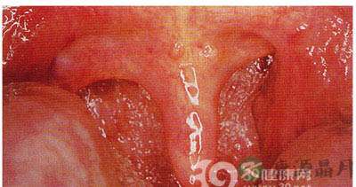 慢性咽炎图片