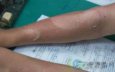 日光性皮炎可能是吃出来的 日光性皮炎可能是吃出来的