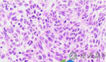 癌症百科：什么是鳞癌？