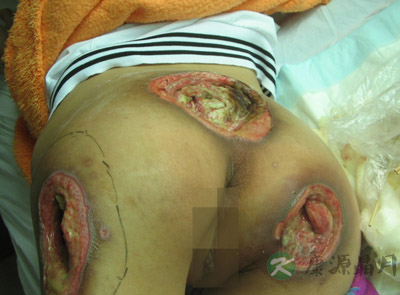 17岁少女患巨大压疮浑然不知