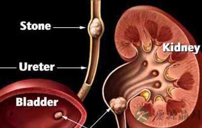肾结石预防和治疗指南